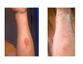 Urushiol induced contact dermatitis.jpg